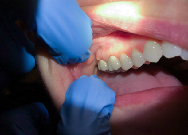 Best Emergency Dentist for Lost Fillings or Crowns in Ozark, MO